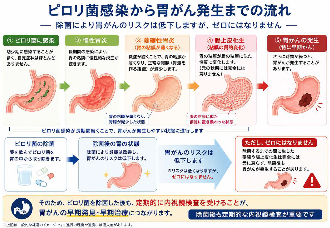 ピロリ 菌 胃がん