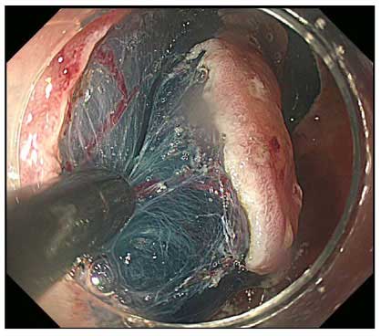 gastrointestinal_cancer_1_m.jpg