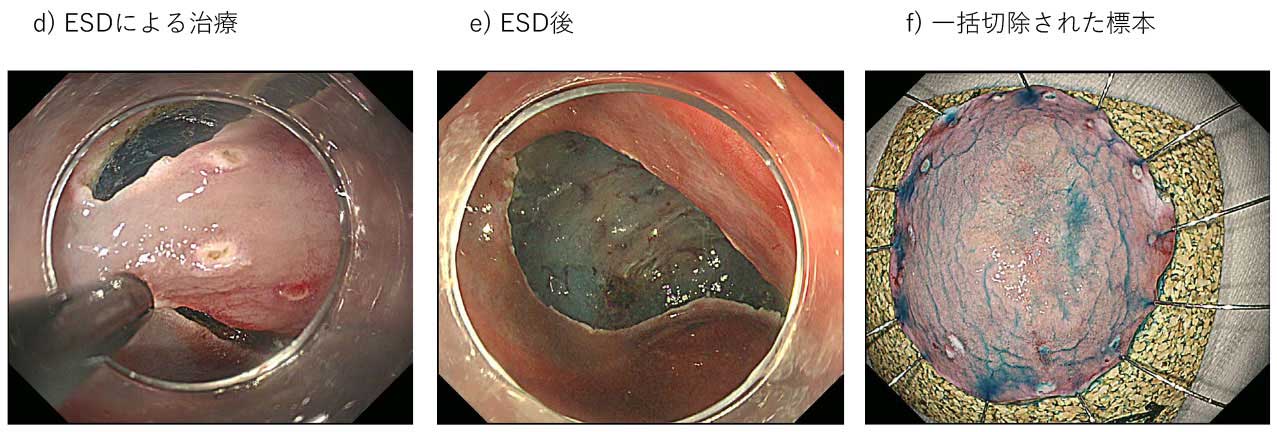 gastrointestinal_cancer_3_m.jpg