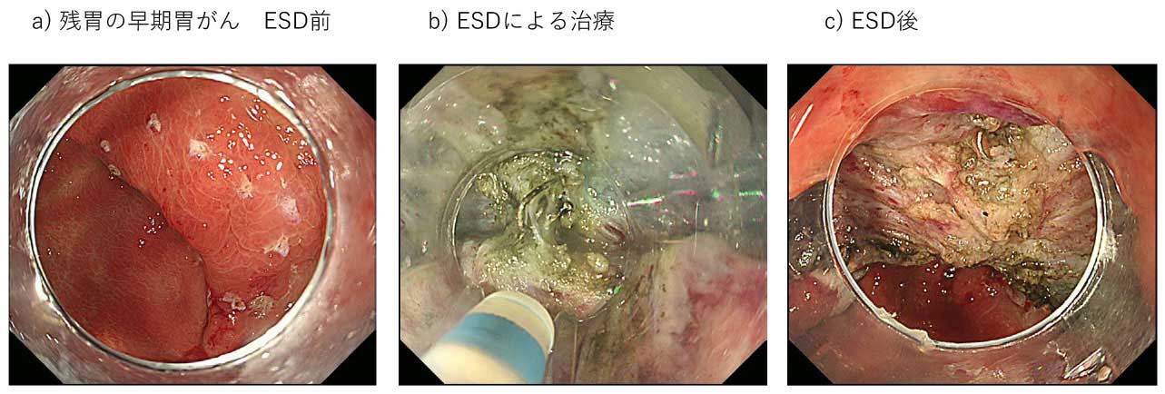 gastrointestinal_cancer_4_m.jpg
