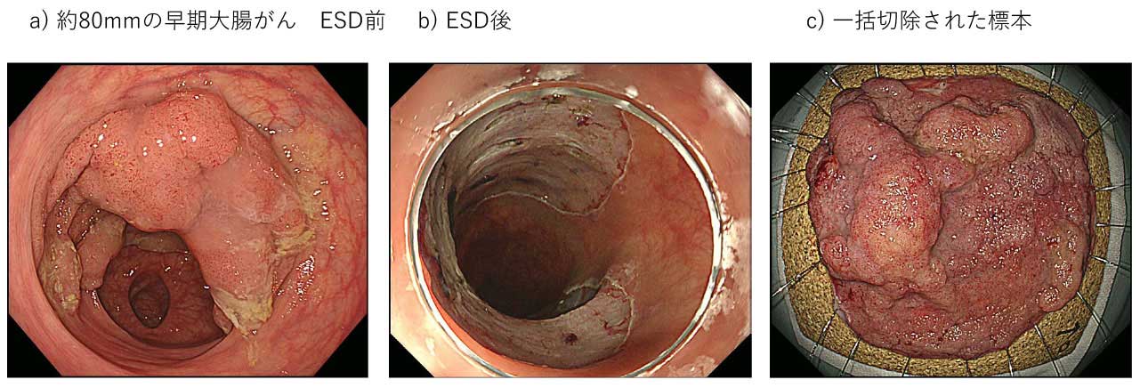 gastrointestinal_cancer_6_m.jpg